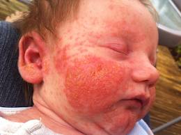 Skin rashes in children - NHS Choices