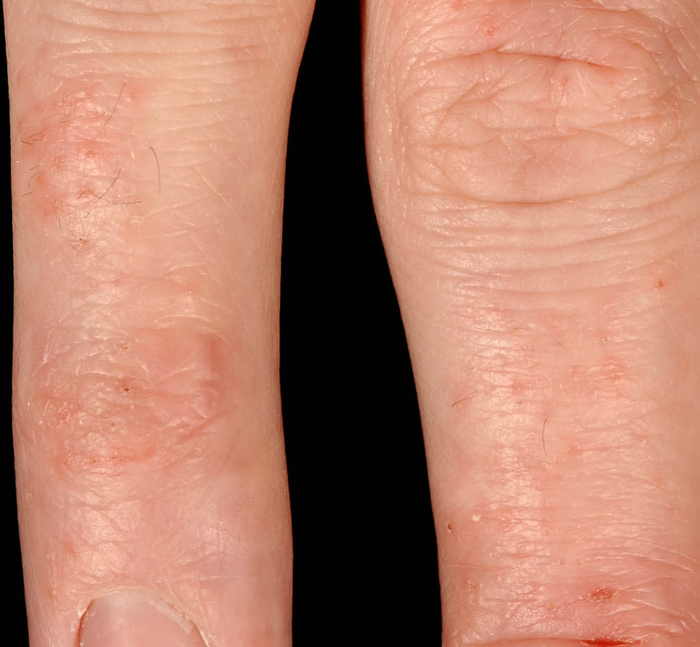 Doctor insights on: Skin Rashes On Legs And Feet - HealthTap