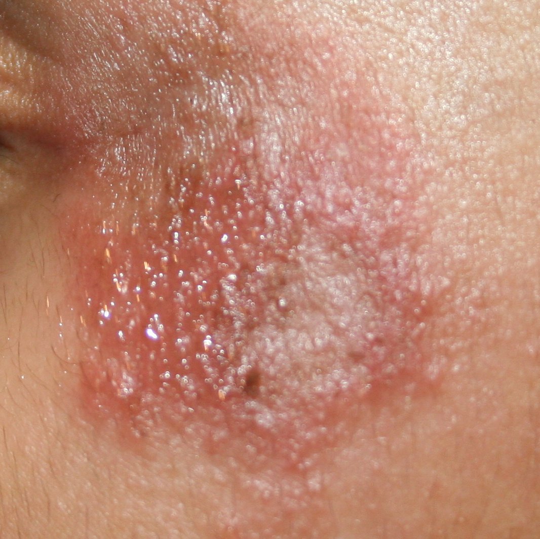 Skin Irritation - Risks, Symptoms and Leading Causes | Treato