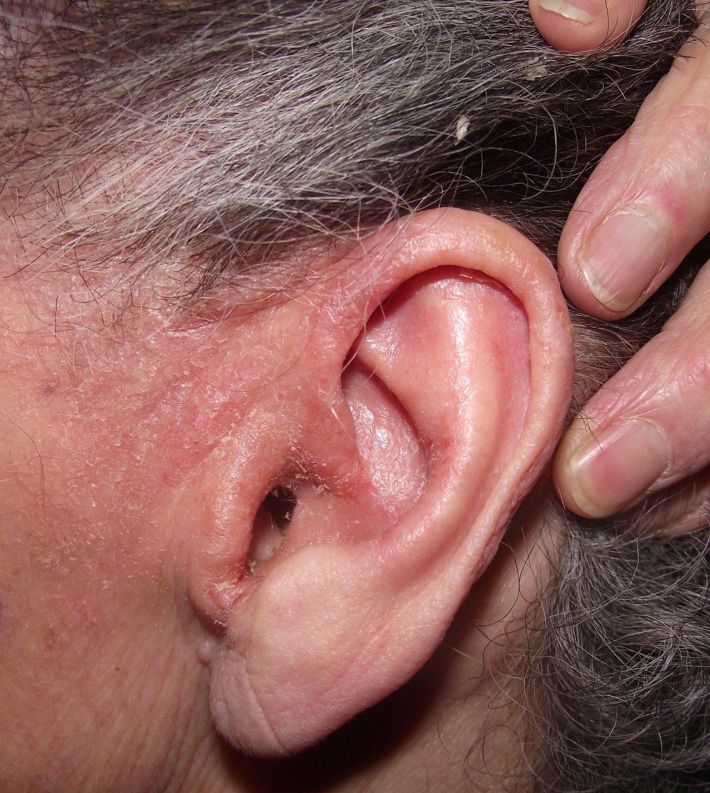 Itchy scalp with rash - RightDiagnosis.com
